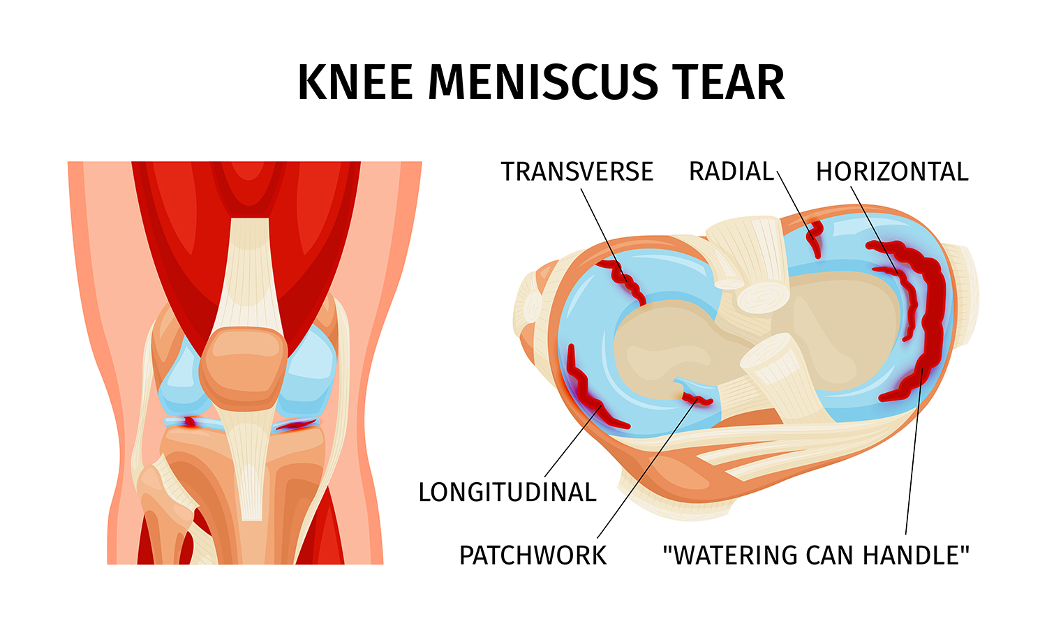 La chirurgie du cartilage